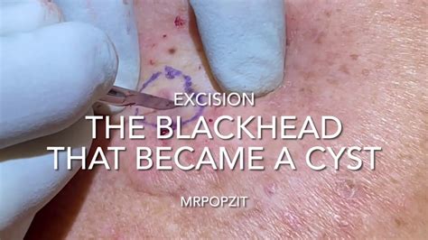 Pictures of ingrown hair cysts. Things To Know About Pictures of ingrown hair cysts. 